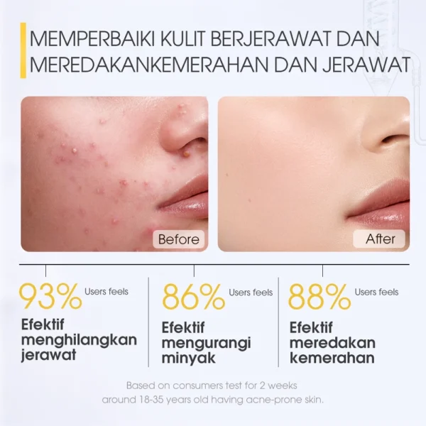 SKINEVER Salicylic Acid Acne Treatment Ice Sleep Masque Acne Soothes and Anti-Acne Skin Leave-on Masker Wajah Mud Mask Eksfoliasi - Image 4